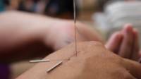 Acupuncture Services